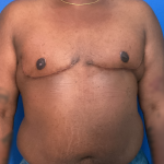 FTM Before & After Patient #1759