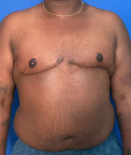 FTM Before & After Patient #1759