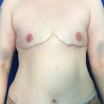 FTM Before & After Patient #1760