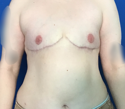 FTM Before & After Patient #1760