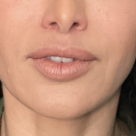 Lip Lift Before & After Patient #1761