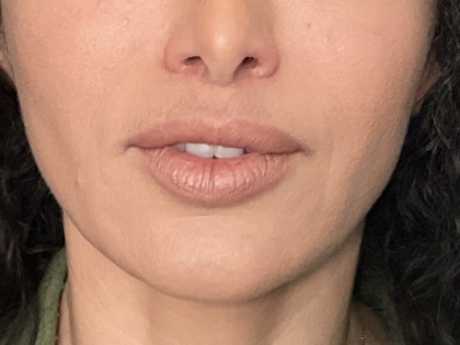 Lip Lift Before & After Patient #1761