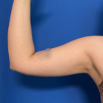 Liposuction Arms Before & After Patient #1762
