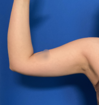 Liposuction Arms Before & After Patient #1762