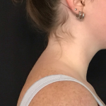 Liposuction of the Back of the Neck Before & After Patient #1763
