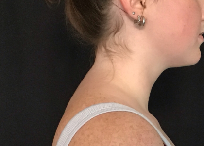 Liposuction of the Back of the Neck Before & After Patient #1763