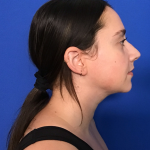 Neck Liposuction Before & After Patient #1764
