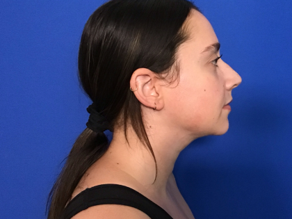 Neck Liposuction Before & After Patient #1764