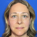 Blepharoplasty Before & After Patient #1765