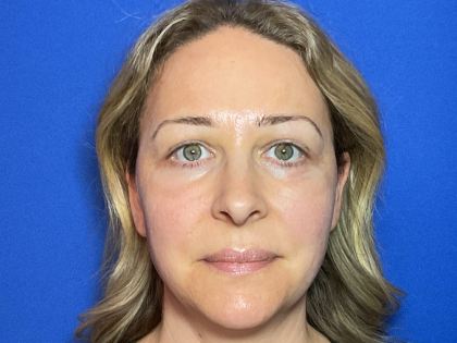 Blepharoplasty Before & After Patient #1765