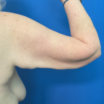 Brachioplasty Before & After Patient #1757