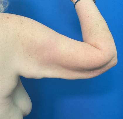 Brachioplasty Before & After Patient #1757