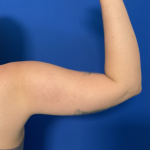 Liposuction Arms Before & After Patient #1762