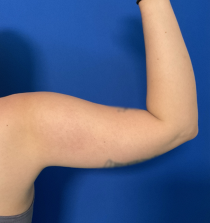 Liposuction Arms Before & After Patient #1762