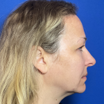 Blepharoplasty Before & After Patient #1765