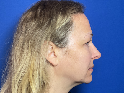 Blepharoplasty Before & After Patient #1765