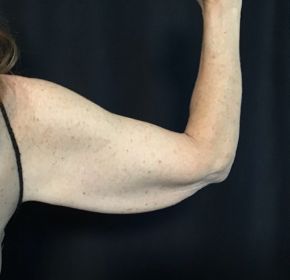 Brachioplasty Before & After Patient #1756