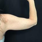Brachioplasty Before & After Patient #1756