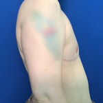 FTM Before & After Patient #1760