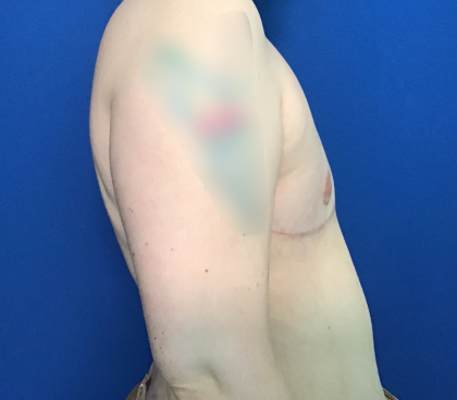 FTM Before & After Patient #1760