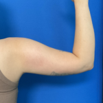 Liposuction Arms Before & After Patient #1762