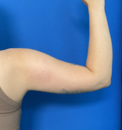 Liposuction Arms Before & After Patient #1762