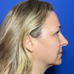 Blepharoplasty Before & After Patient #1765