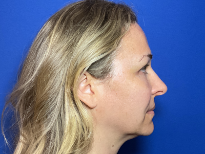 Blepharoplasty Before & After Patient #1765
