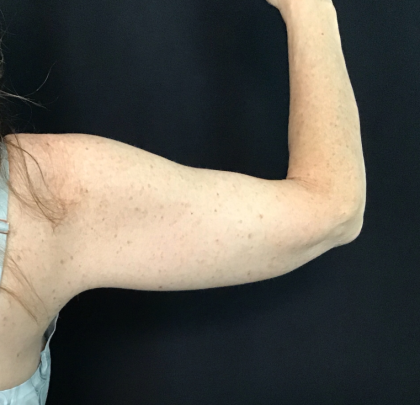 Brachioplasty Before & After Patient #1756
