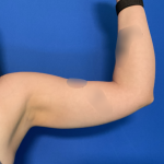 Liposuction Arms Before & After Patient #1762