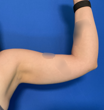 Liposuction Arms Before & After Patient #1762