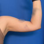 Liposuction Arms Before & After Patient #1762