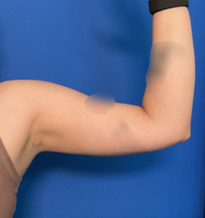 Liposuction Arms Before & After Patient #1762