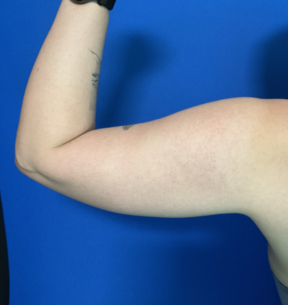Liposuction Arms Before & After Patient #1762