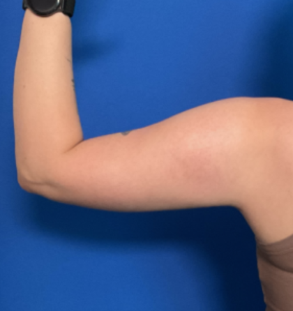Liposuction Arms Before & After Patient #1762