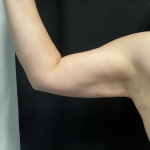 Brachioplasty Before & After Patient #1823
