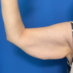 Brachioplasty Before & After Patient #1838