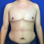 FTM Before & After Patient #1833