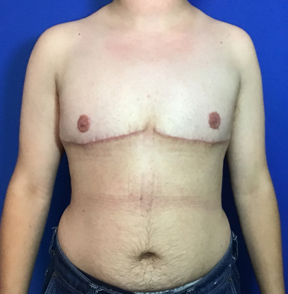 FTM Before & After Patient #1833