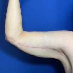 Brachioplasty Before & After Patient #1838