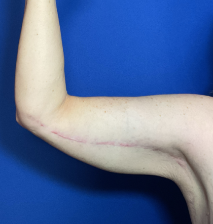 Brachioplasty Before & After Patient #1838