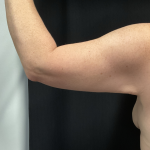 Brachioplasty Before & After Patient #1823
