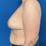Breast Reduction Before & After Patient #1824