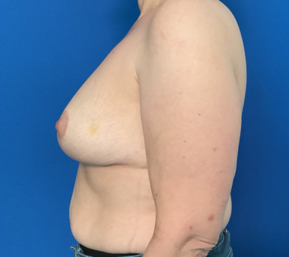 Breast Reduction Before & After Patient #1824