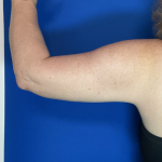 Brachioplasty Before & After Patient #1823