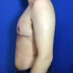 FTM Before & After Patient #1833