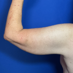 Brachioplasty Before & After Patient #1838