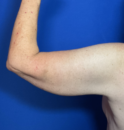 Brachioplasty Before & After Patient #1838