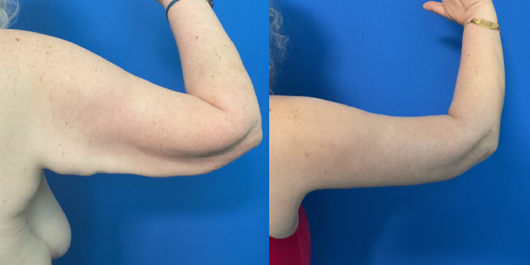 semaglutide boulder Best Medical Weight Loss Boulder, CO