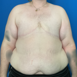 FTM Before & After Patient #1887